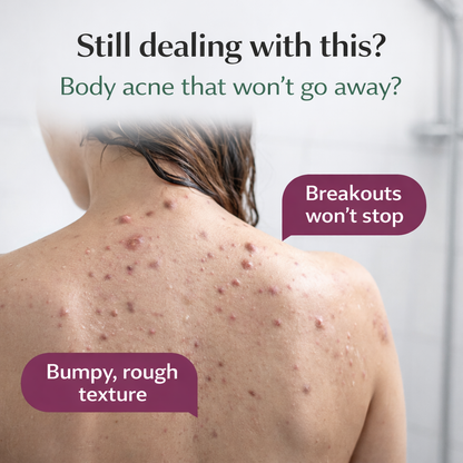 Lucrown™ Acne Wash